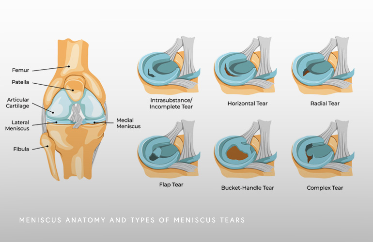 Types of Meniscus Tears